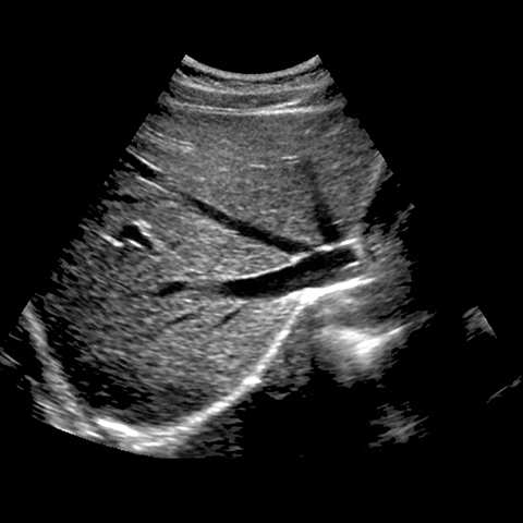 ultrasound of liver